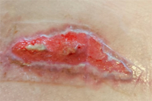 Deiscência de sutura